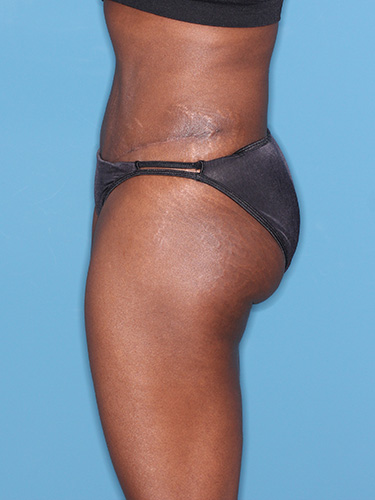 Case--39563 | After True Form Tummy Tuck® 5