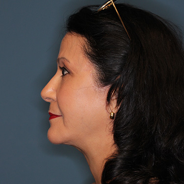 Case--40089 | After Eyelid Surgery (Blepharoplasty) 5