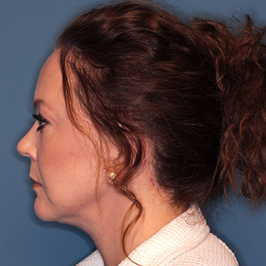 Case--40200 | After Facelift and Neck Lift 5
