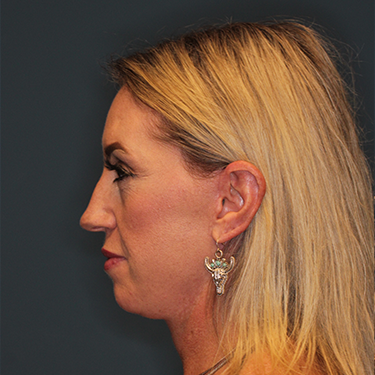 Case--43126 | After Eyelid Surgery (Blepharoplasty) 5