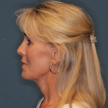 Case--837079 | After Brow Lift 5