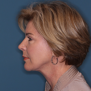 Case--38239 | After Eyelid Surgery (Blepharoplasty) 5