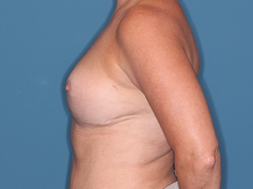 Case--36546 | After Corrective/Revision Breast Implant Surgery 5