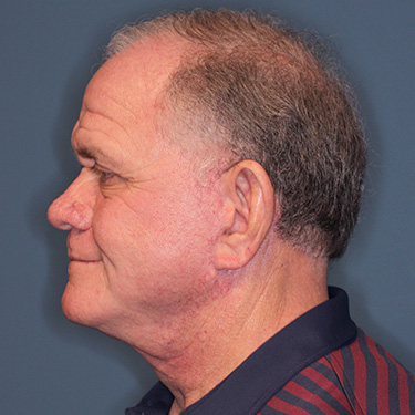 Case--40393 | After Facelift and Neck Lift for Men 5