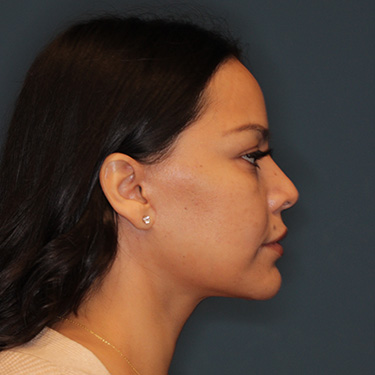 Case--42025 | After Facelift and Neck Lift 4