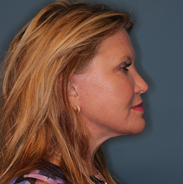 Case--41496 | After Eyelid Surgery (Blepharoplasty) 4