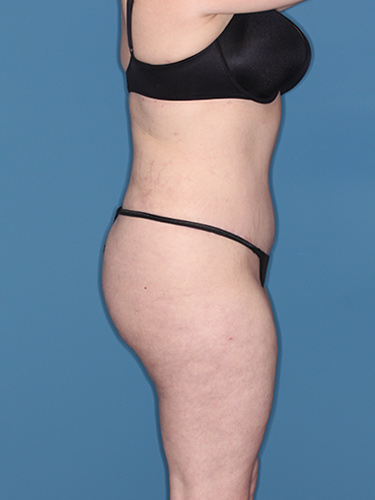 Case--37146 | After Liposuction 4