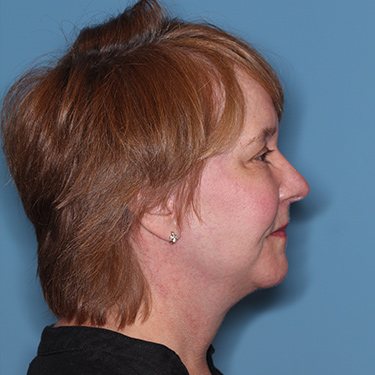 Case--36018 | After Eyelid Surgery (Blepharoplasty) 3