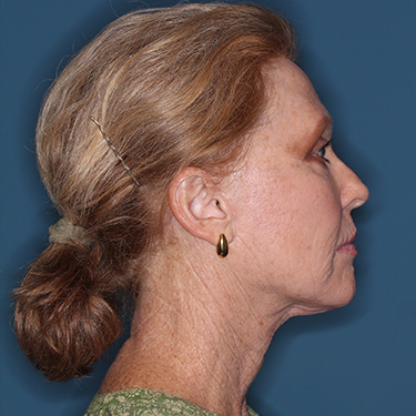 Case--36727 | After Facelift and Neck Lift 4