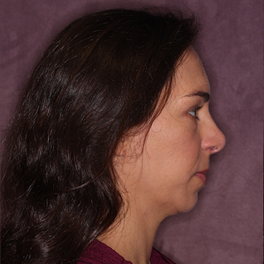 Case--36005 | After Nose Surgery (Rhinoplasty) 3