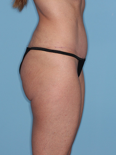 Case--39580 | After Liposuction 4