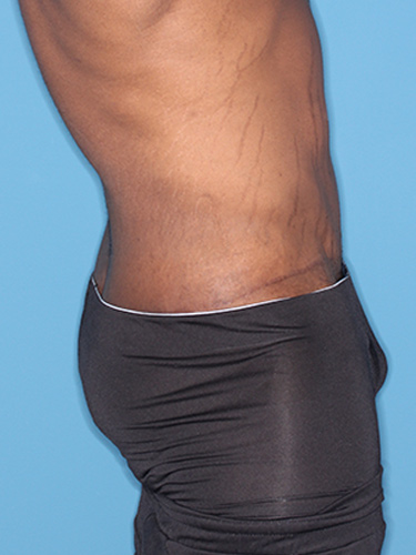 Case--36791 | After Body Lift for Men 4