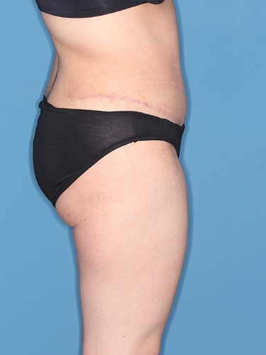 Case--37542 | After Liposuction 4
