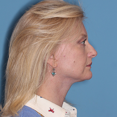 Case--36776 | After Brow Lift 4