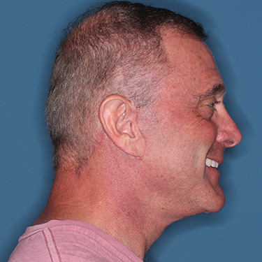 Case--41459 | After Facelift and Neck Lift for Men 4
