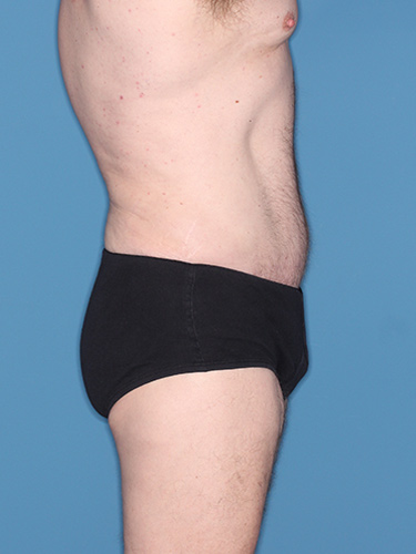 Case--36843 | After Liposuction for Men 5