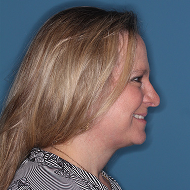 Case--36591 | After Facelift and Neck Lift 4