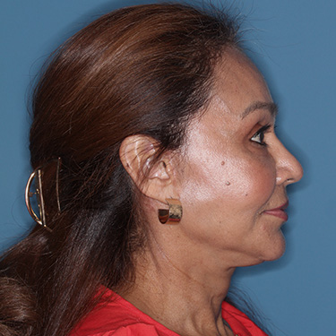 Case--38938 | After Eyelid Surgery (Blepharoplasty) 4