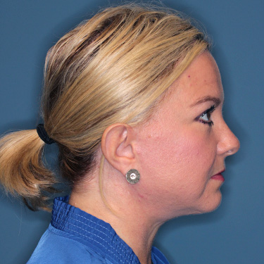 Case--39150 | After Eyelid Surgery (Blepharoplasty) 4