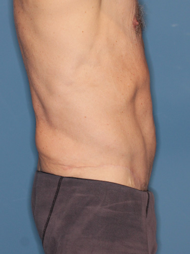 Case--40026 | After True Form Tummy Tuck® for Men 4