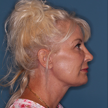 Case--40232 | After Facelift and Neck Lift 4
