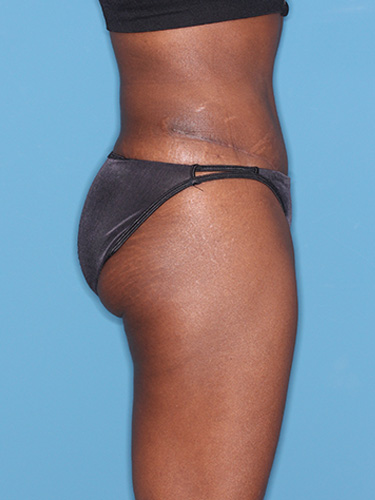 Case--39563 | After True Form Tummy Tuck® 4