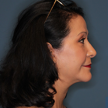 Case--40089 | After Eyelid Surgery (Blepharoplasty) 4