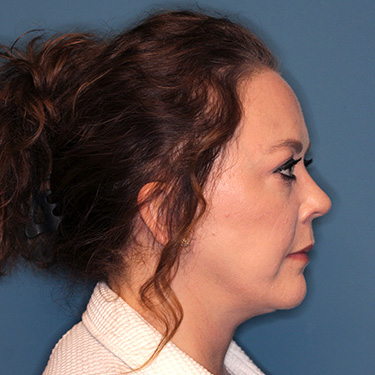 Case--40200 | After Facelift and Neck Lift 4