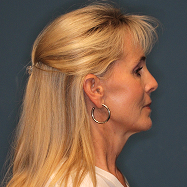 Case--837079 | After Brow Lift 3