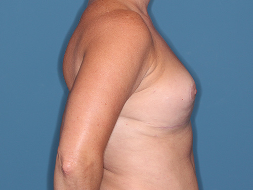 Case--36546 | After Corrective/Revision Breast Implant Surgery 4