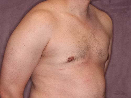 Case--32298 | After Gynecomastia 3