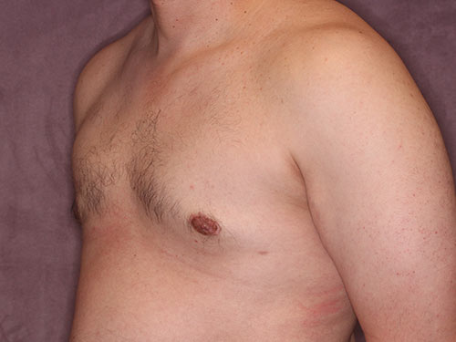 Case--32298 | After Gynecomastia 2
