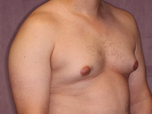 Case--32298 | Before Gynecomastia 3