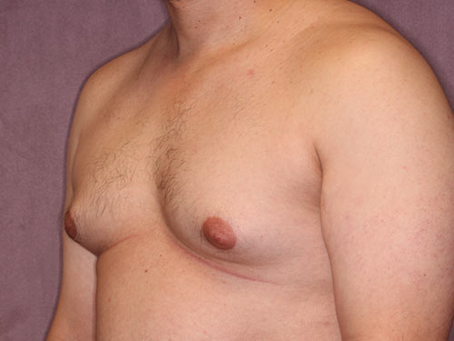Case--32298 | Before Gynecomastia 2