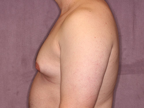 Case--32298 | Before Gynecomastia 1