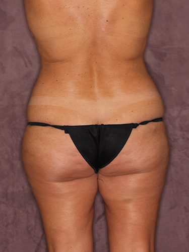 Case--36417 | Before Fat Transfer to Buttocks 6