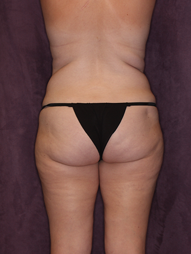 Case--43052 | Before Liposuction 6
