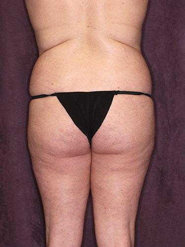 Case--37146 | Before Liposuction 6