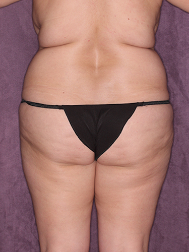 Case--39208 | Before Liposuction 6