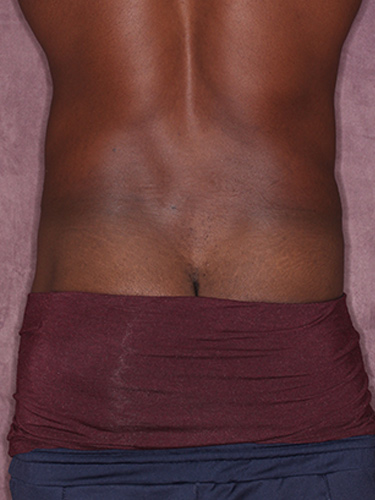 Case--36791 | Before Body Lift for Men 6