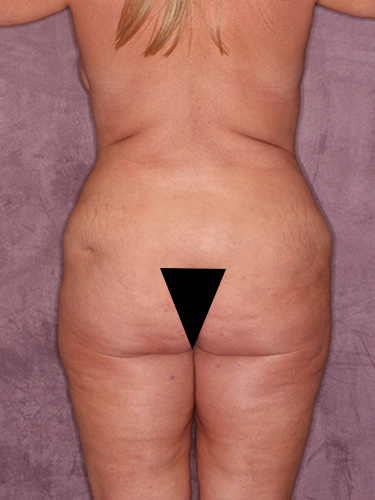 Case--37163 | Before Liposuction 6