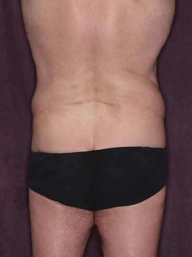 Case--36843 | Before Liposuction for Men 6