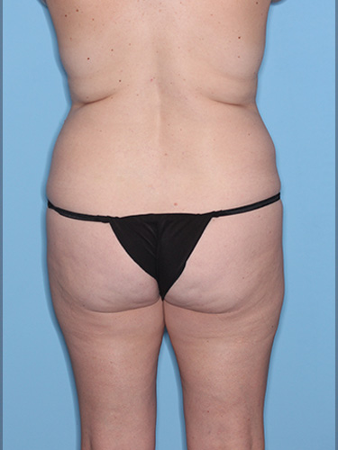 Case--40481 | Before Liposuction 6