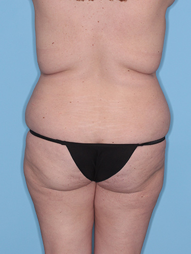 Case--37797 | Before Fat Transfer to Buttocks 6