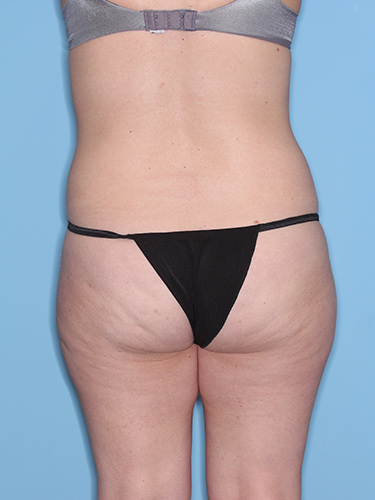 Case--38188 | Before Liposuction 6