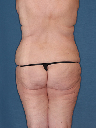 Case--40335 | Before True Form Tummy Tuck® in Overweight & Weight Loss Patients 6