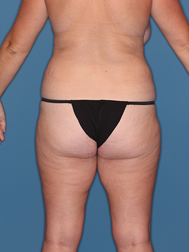 Case--45151 | Before Liposuction 6