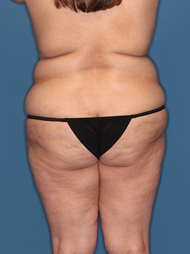 Case--39995 | Before Lower Body Lift (Buttock Lift) 6