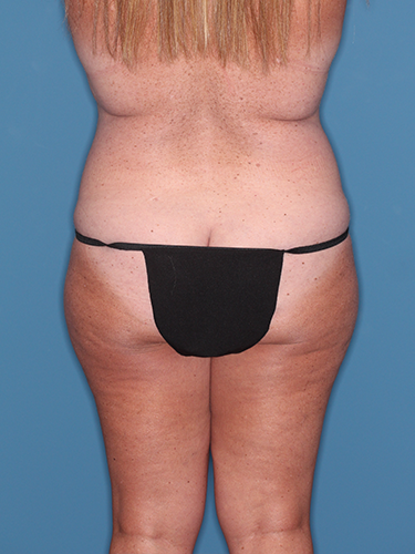 Case--45006 | Before Breast Lift with Breast Reduction 6