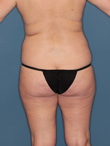 Case--43546 | Before Liposuction 6